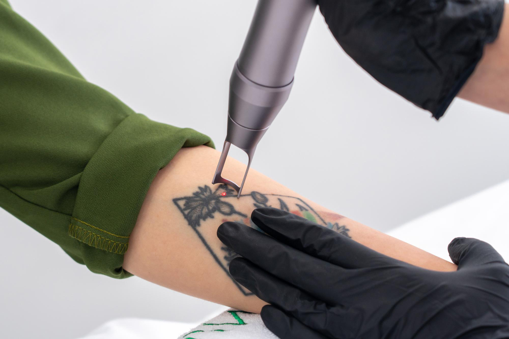 Laser Tattoo Removal