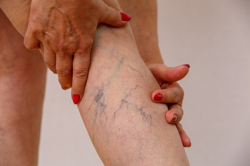 Laser Vein and Lesion Treatment